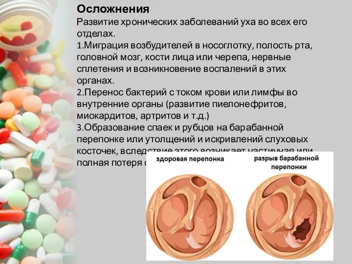 Осложнения Развитие хронических заболеваний уха во всех его отделах. 1.Миграция