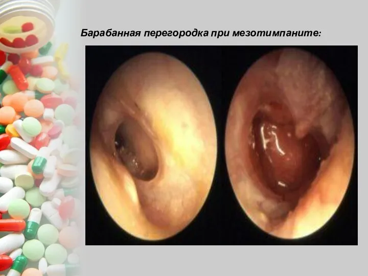 Барабанная перегородка при мезотимпаните: