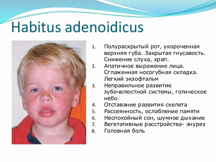 Habitus adenoidicus Полураскрытый рот, укороченная верхняя губа. Закрытая гнусавость. Снижение