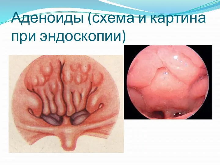 Аденоиды (схема и картина при эндоскопии)