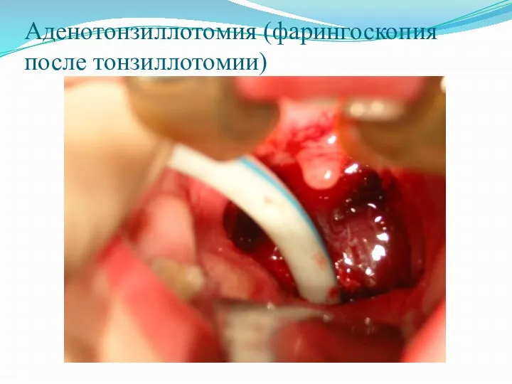 Аденотонзиллотомия (фарингоскопия после тонзиллотомии)