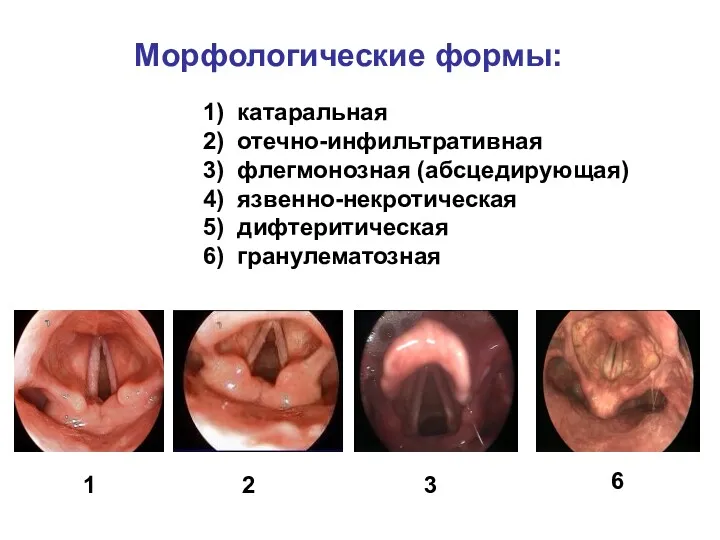 1) катаральная 2) отечно-инфильтративная 3) флегмонозная (абсцедирующая) 4) язвенно-некротическая 5)