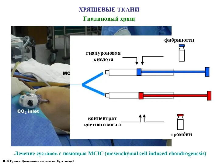 ХРЯЩЕВЫЕ ТКАНИ Гиалиновый хрящ Лечение суставов с помощью MCIC (mesenchymal