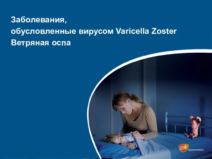 Заболевания, обусловленные вирусом Varicella Zoster Ветряная оспа