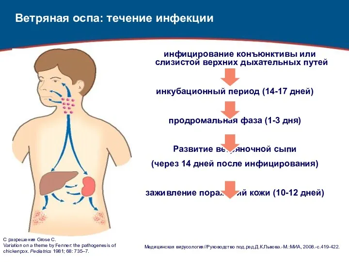 Ветряная оспа: течение инфекции инфицирование конъюнктивы или слизистой верхних дыхательных путей инкубационный период