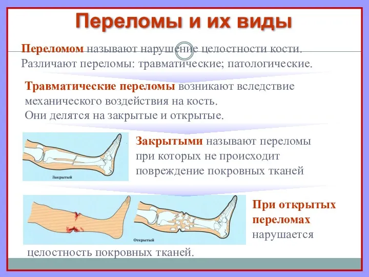 Переломы и их виды При открытых переломах нарушается Переломом называют