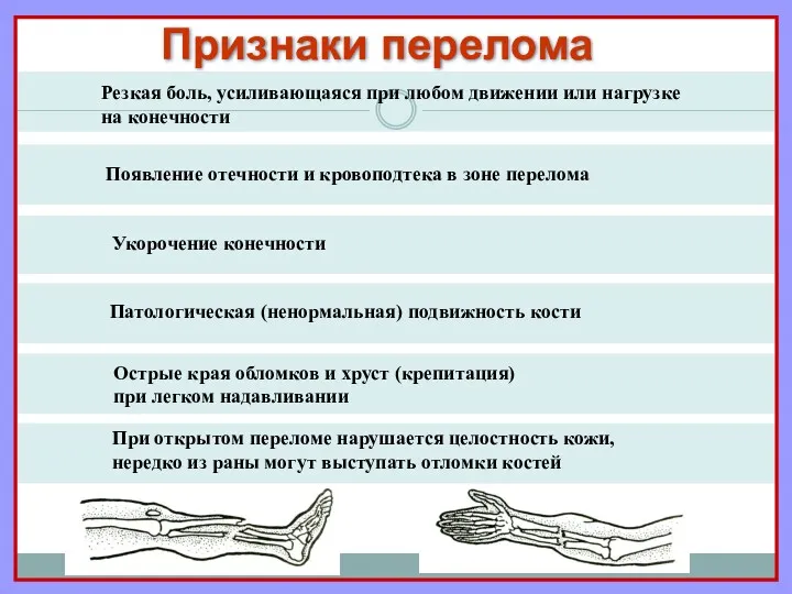 Признаки перелома Резкая боль, усиливающаяся при любом движении или нагрузке