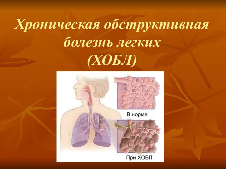 Хроническая обструктивная болезнь легких (ХОБЛ)