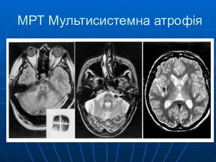 МРТ Мультисистемна атрофія