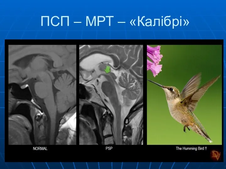 ПСП – МРТ – «Калібрі»