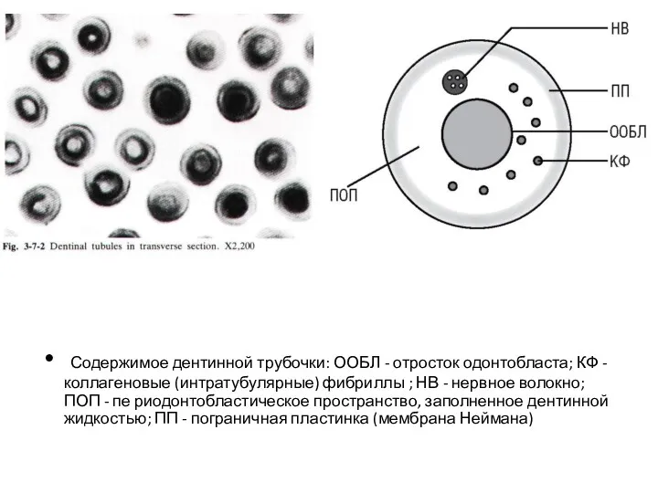 Содержимое дентинной трубочки: ООБЛ - отросток одонтобласта; КФ - коллагеновые
