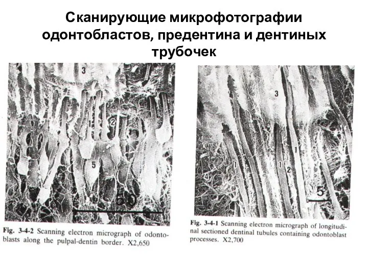 Сканирующие микрофотографии одонтобластов, предентина и дентиных трубочек