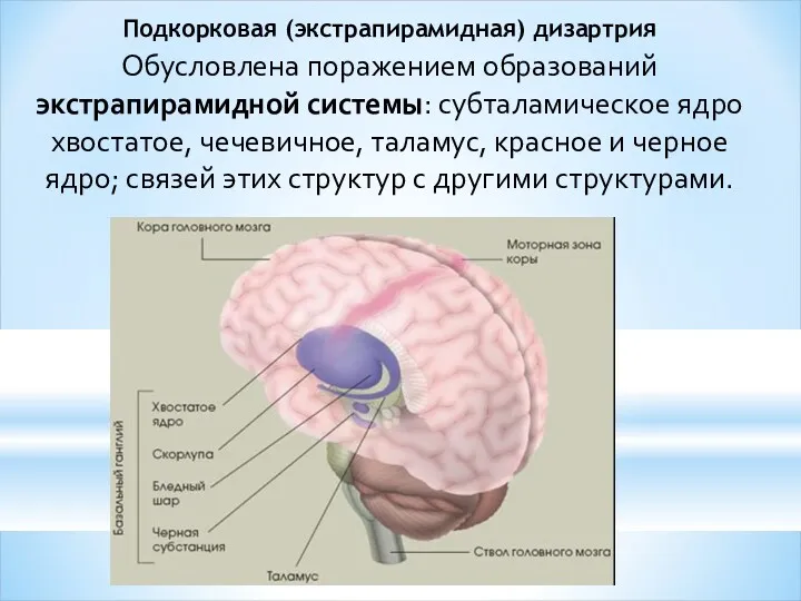 Подкорковая (экстрапирамидная) дизартрия Обусловлена поражением образований экстрапирамидной системы: субталамическое ядро