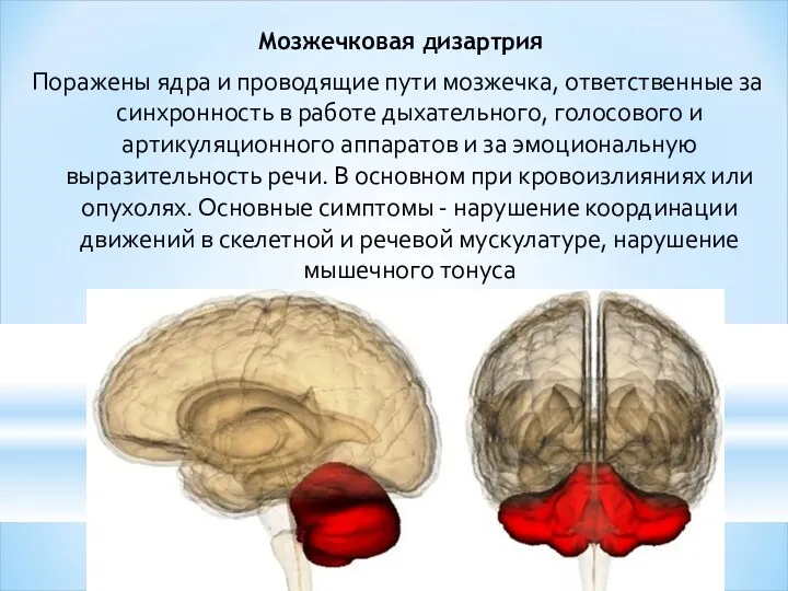 Мозжечковая дизартрия Поражены ядра и проводящие пути мозжечка, ответственные за