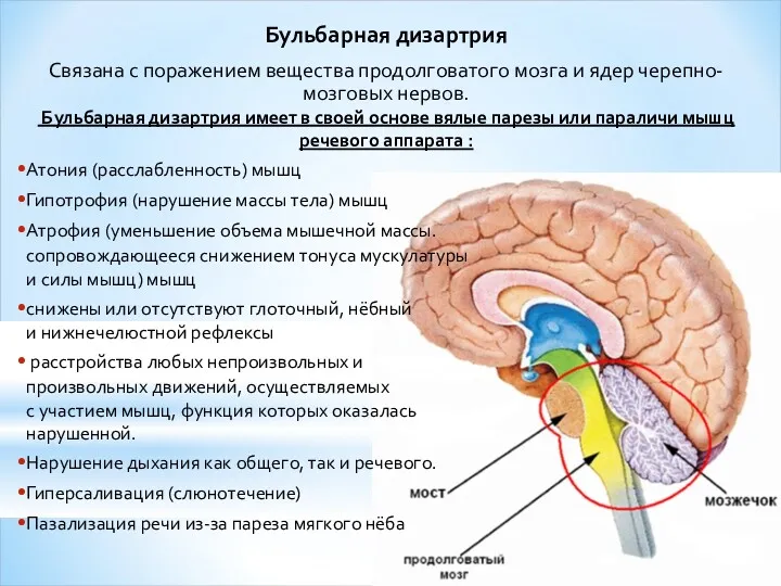 Бульбарная дизартрия Связана с поражением вещества продолговатого мозга и ядер