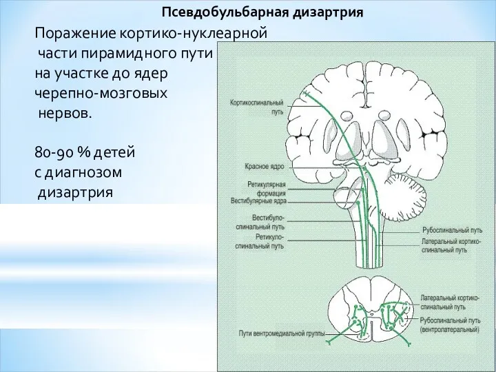 Псевдобульбарная дизартрия Поражение кортико-нуклеарной части пирамидного пути на участке до