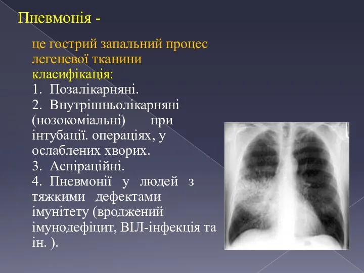 Пневмонія - це гострий запальний процес легеневої тканини класифікація: 1. Позалікарняні. 2. Внутрішньолікарняні