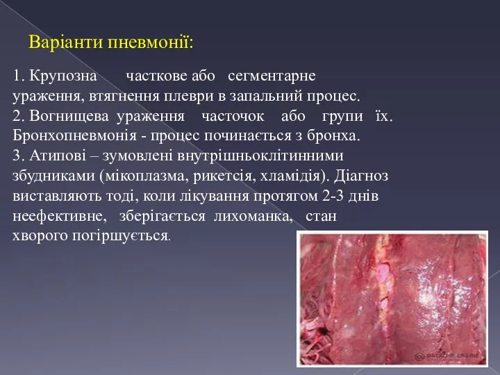 Варіанти пневмонії: 1. Крупозна часткове або сегментарне ураження, втягнення плеври в запальний процес.