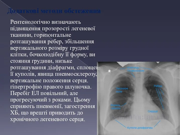 Додаткові методи обстеження Рентенологічно визначають підвищення прозорості легеневої тканини, горизонтальне