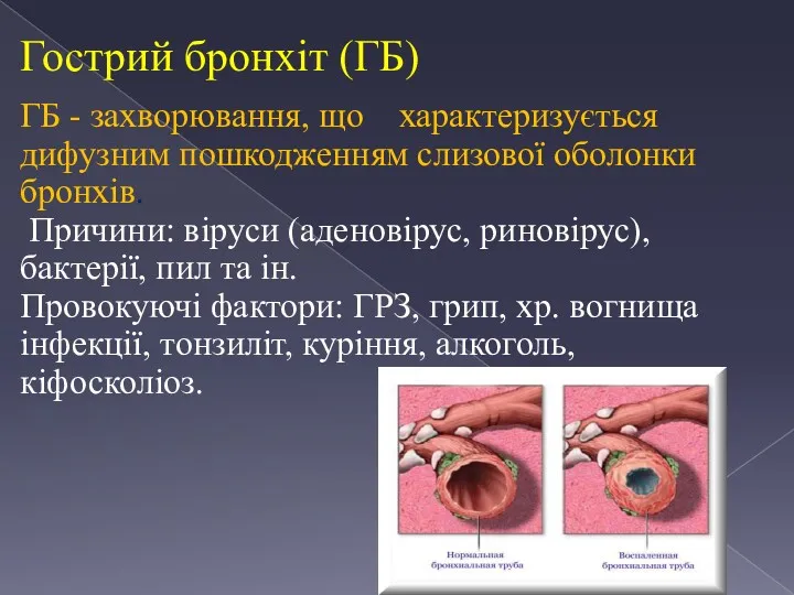 Гострий бронхіт (ГБ) ГБ - захворювання, що характеризується дифузним пошкодженням