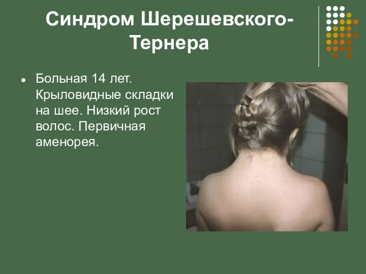 Синдром Шерешевского-Тернера Больная 14 лет. Крыловидные складки на шее. Низкий рост волос. Первичная аменорея.