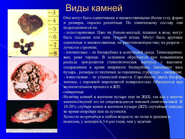 Виды камней Они могут быть одиночными и множественными (более ста),