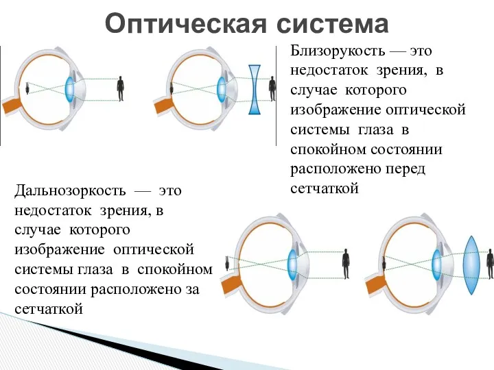 Оптическая система Близорукость — это недостаток зрения, в случае которого