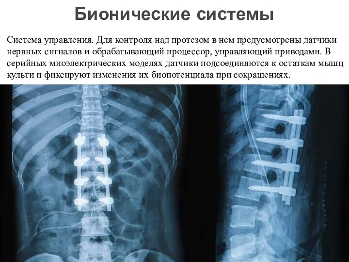 Система управления. Для контроля над протезом в нем предусмотрены датчики