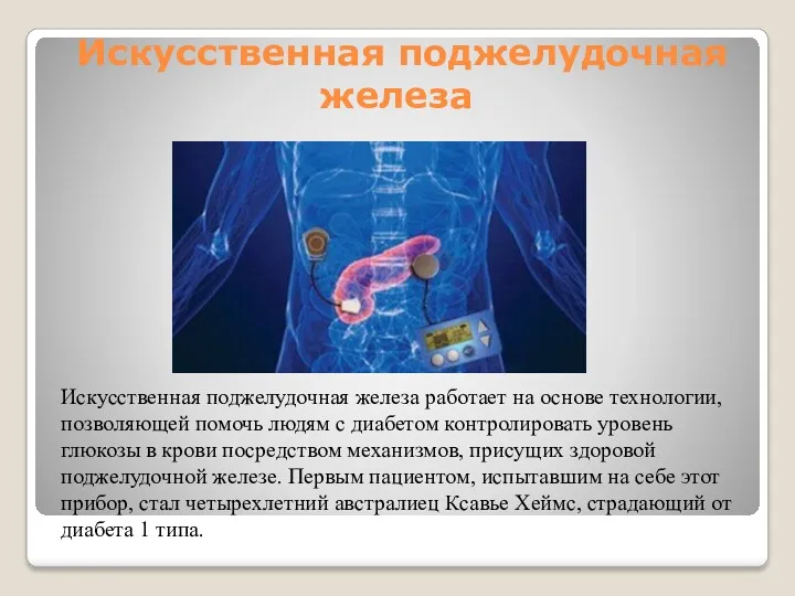 Искусственная поджелудочная железа Искусственная поджелудочная железа работает на основе технологии,