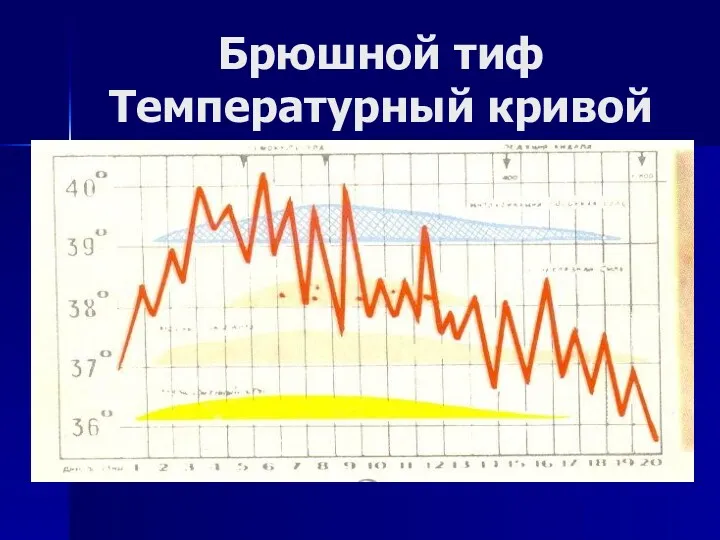 Брюшной тиф Температурный кривой