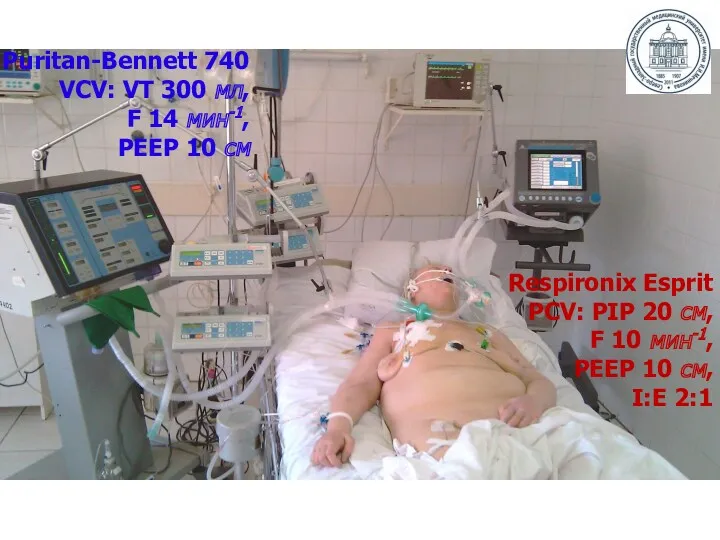 Respironix Esprit PCV: PIP 20 см, F 10 мин-1, РЕЕР