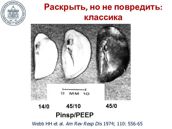 Раскрыть, но не повредить: классика Webb HH et al. Am Rev Resp Dis 1974; 110: 556-65