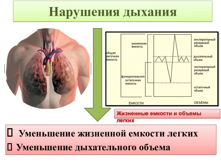 Нарушения дыхания Уменьшение жизненной емкости легких Уменьшение дыхательного объема Жизненные емкости и объемы легких