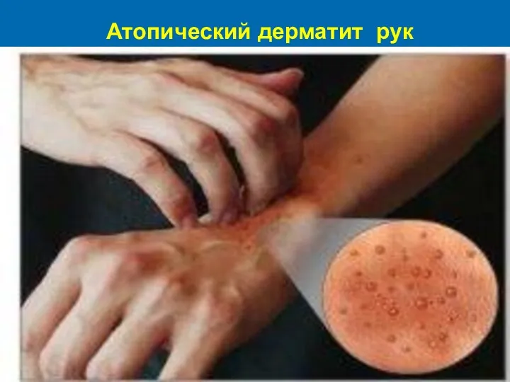 Атопический дерматит рук