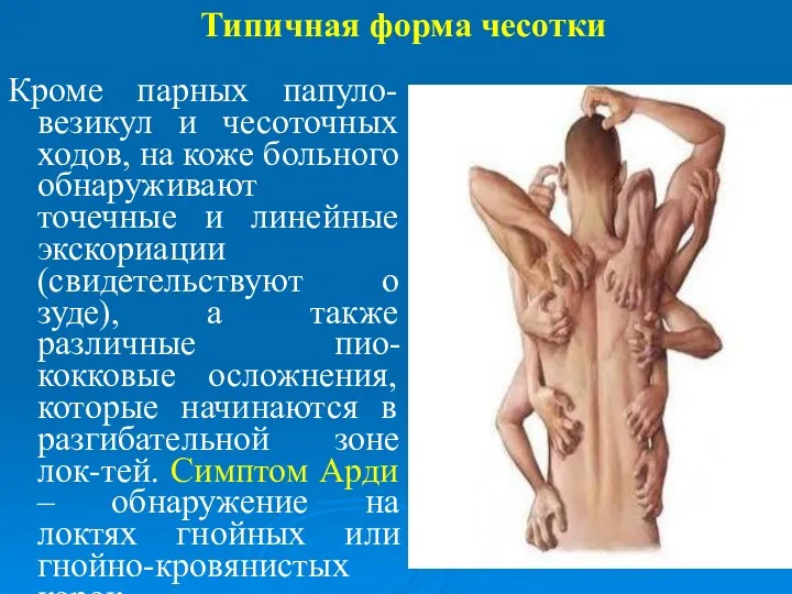 Типичная форма чесотки Кроме парных папуло-везикул и чесоточных ходов, на коже больного обнаруживают