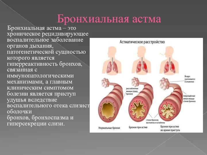 Бронхиальная астма Бронхиальная астма – это хроническое рецидивирующее воспалительное заболевание