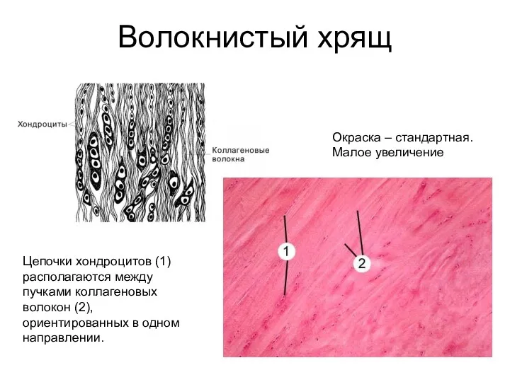 Волокнистый хрящ Цепочки хондроцитов (1) располагаются между пучками коллагеновых волокон