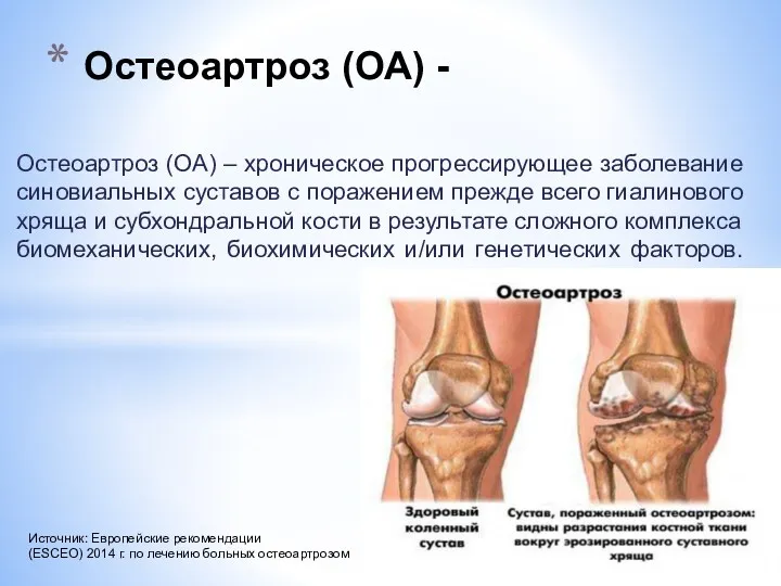 Остеоартроз (ОА) – хроническое прогрессирующее заболевание синовиальных суставов с поражением