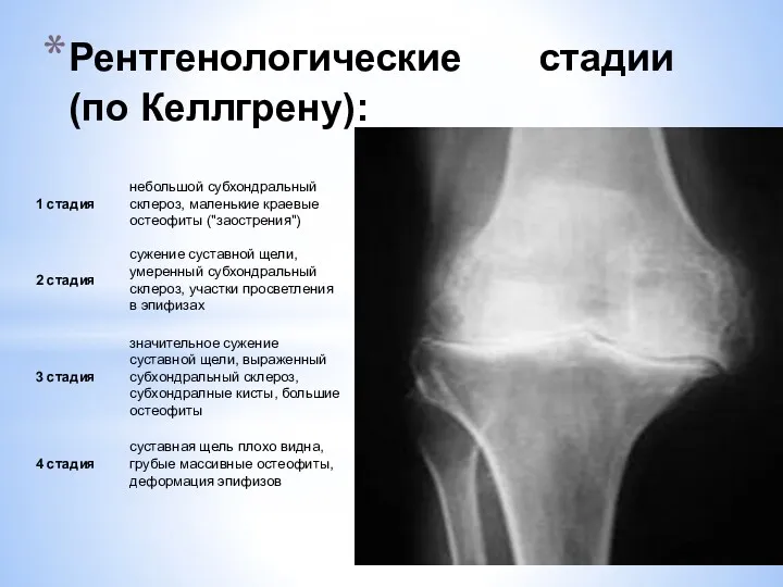 Рентгенологические стадии (по Келлгрену):