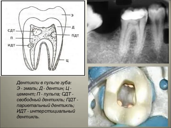 Дентикли в пульпе зуба: Э - эмаль; Д - дентин;