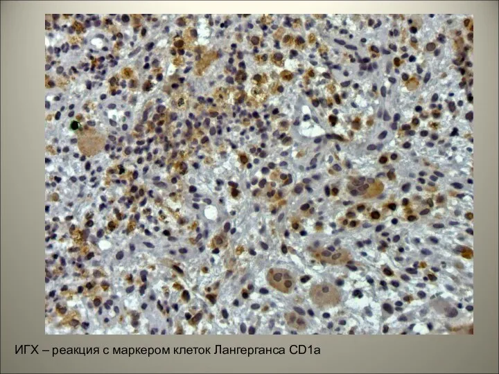 ИГХ – реакция с маркером клеток Лангерганса CD1a