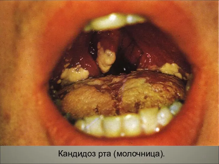 Кандидоз рта (молочница).