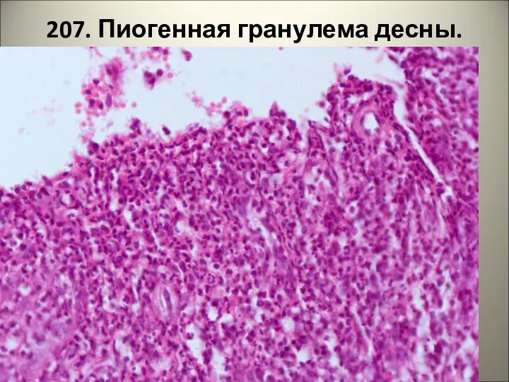 207. Пиогенная гранулема десны.