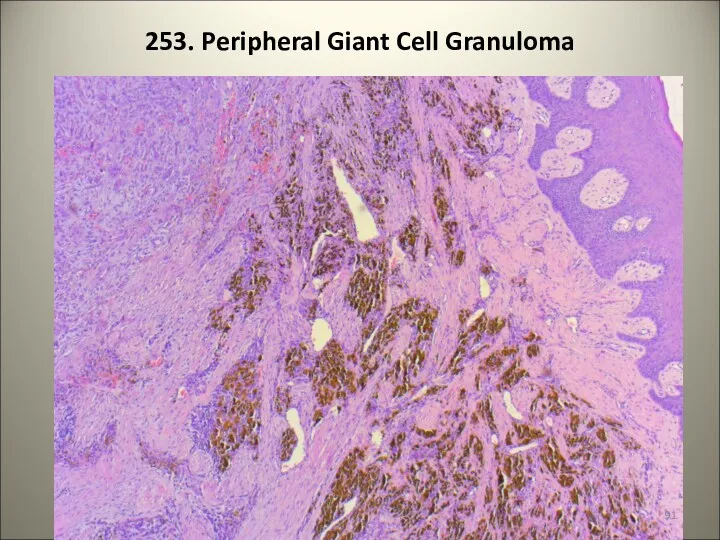 253. Peripheral Giant Cell Granuloma