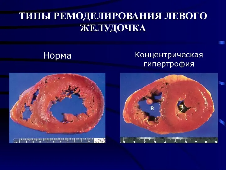 ТИПЫ РЕМОДЕЛИРОВАНИЯ ЛЕВОГО ЖЕЛУДОЧКА