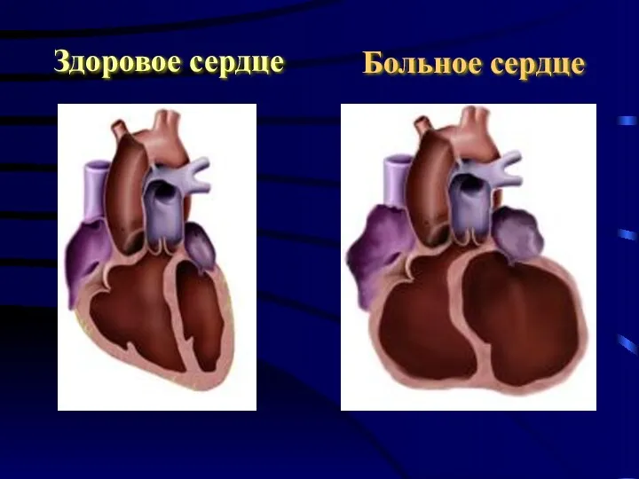 Здоровое сердце Больное сердце