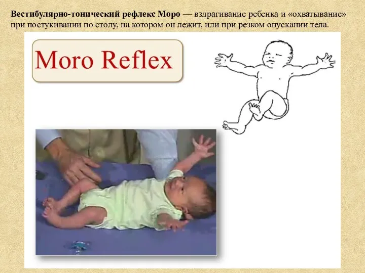 Вестибулярно-тонический рефлекс Моро — вздрагивание ребенка и «охватывание» при постукивании