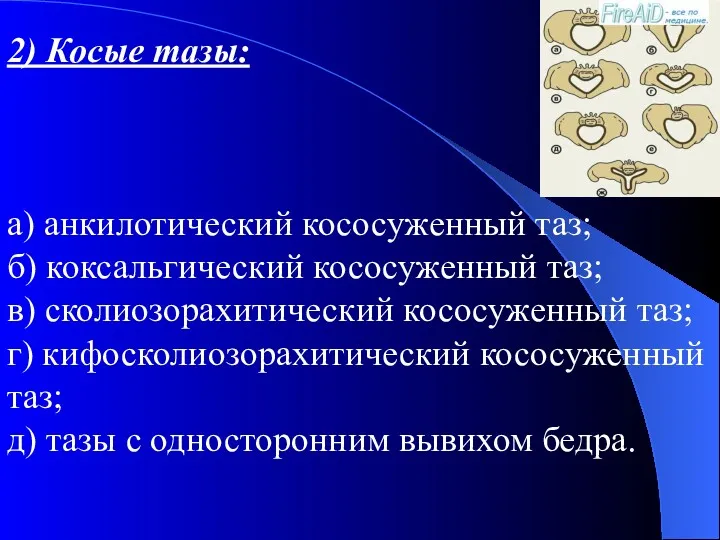 2) Косые тазы: а) анкилотический кососуженный таз; б) коксальгический кососуженный