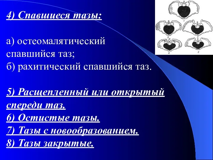 4) Спавшиеся тазы: а) остеомалятический спавшийся таз; б) рахитический спавшийся