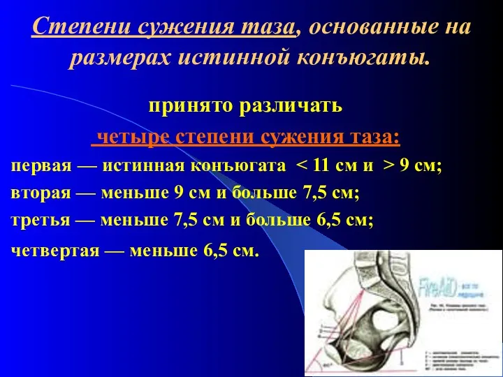 Степени сужения таза, основанные на размерах истинной конъюгаты. принято различать